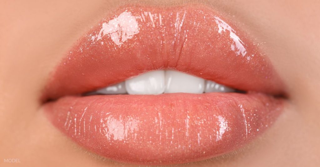 Plump lips after lip filler (MODEL) with lip gloss on.